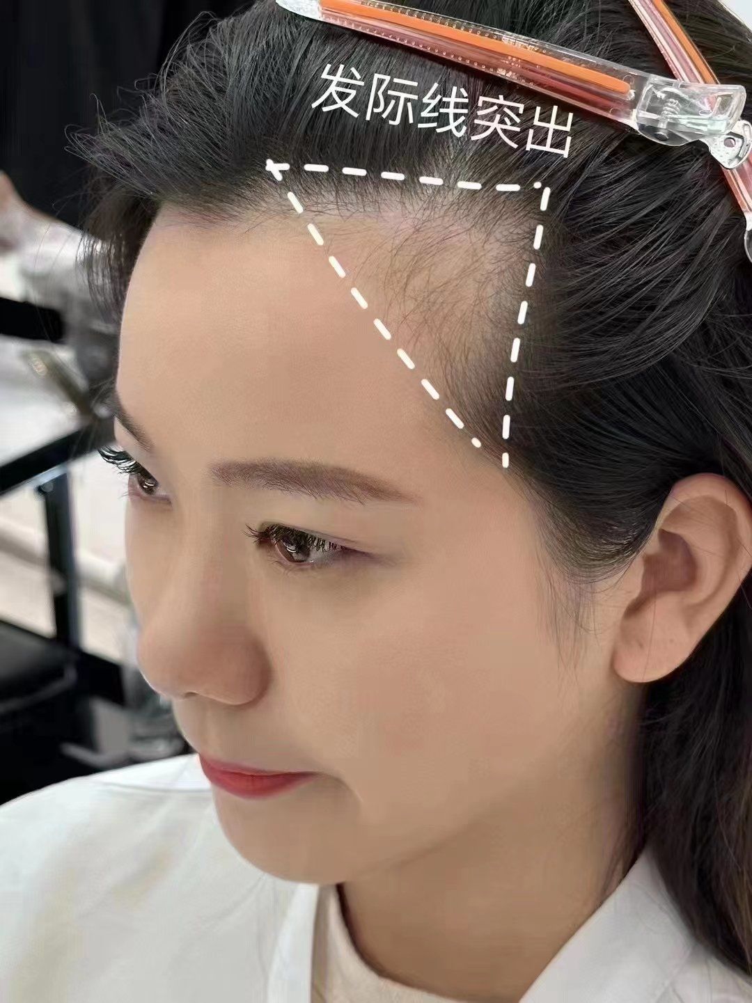 发际线后移的女生有福啦 高额头