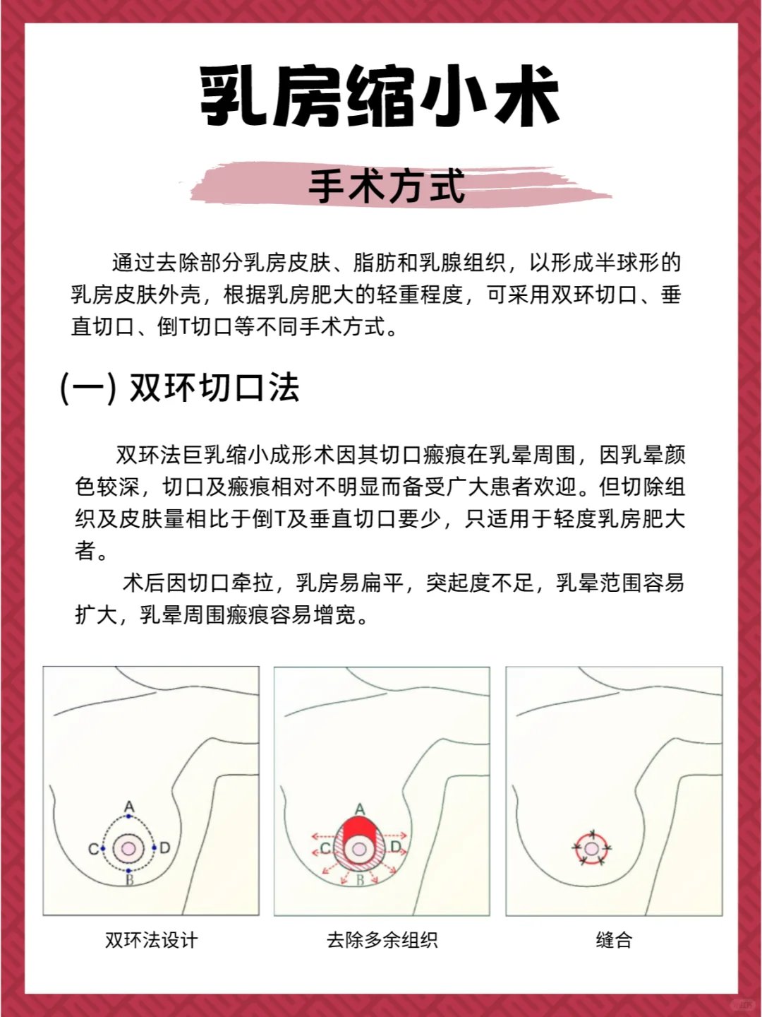 乳房缩小手术要多少钱图片