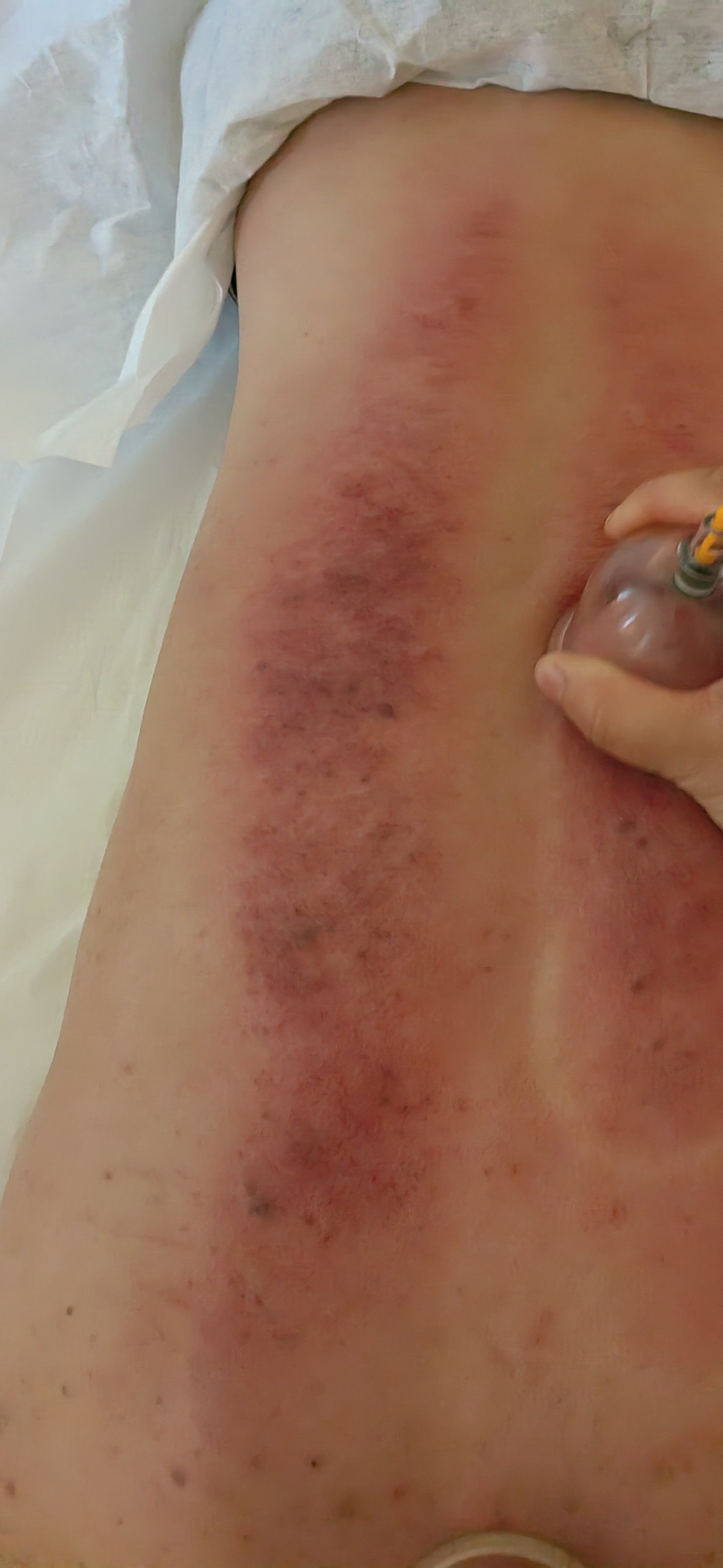 拔罐:祛湿驱寒,缓解酸痛