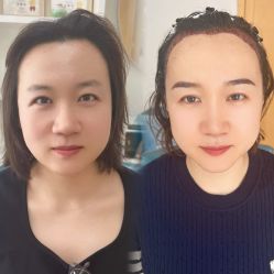 -大麦微针植发丨全国连锁