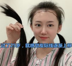 -碧莲盛·不剃发植发
