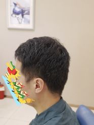 体验后-大麦微针植发丨全国连锁