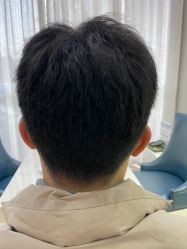 体验后-大麦微针植发丨全国连锁