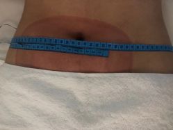 -肥三针腧穴瘦身馆