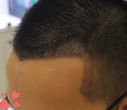 -大麦微针植发丨全国连锁