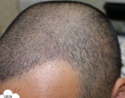 -大麦微针植发丨全国连锁