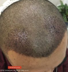 -大麦微针植发丨全国连锁