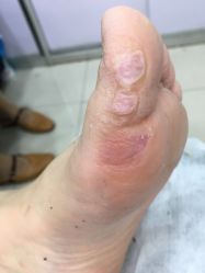 -德哥灰指甲脚气甲沟炎跖疣护理