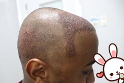 点击看大图 -大麦微针植发丨全国连锁