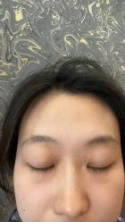 -美丽人生祛斑扁平疣汗管瘤中心