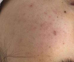 -蕾特恩专业祛痘·皮肤管理