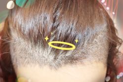 -大麦微针植发全国连锁