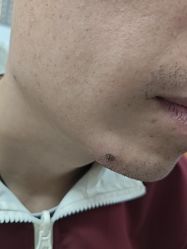 -北京美痣堂古方祛痣斑疣瘊