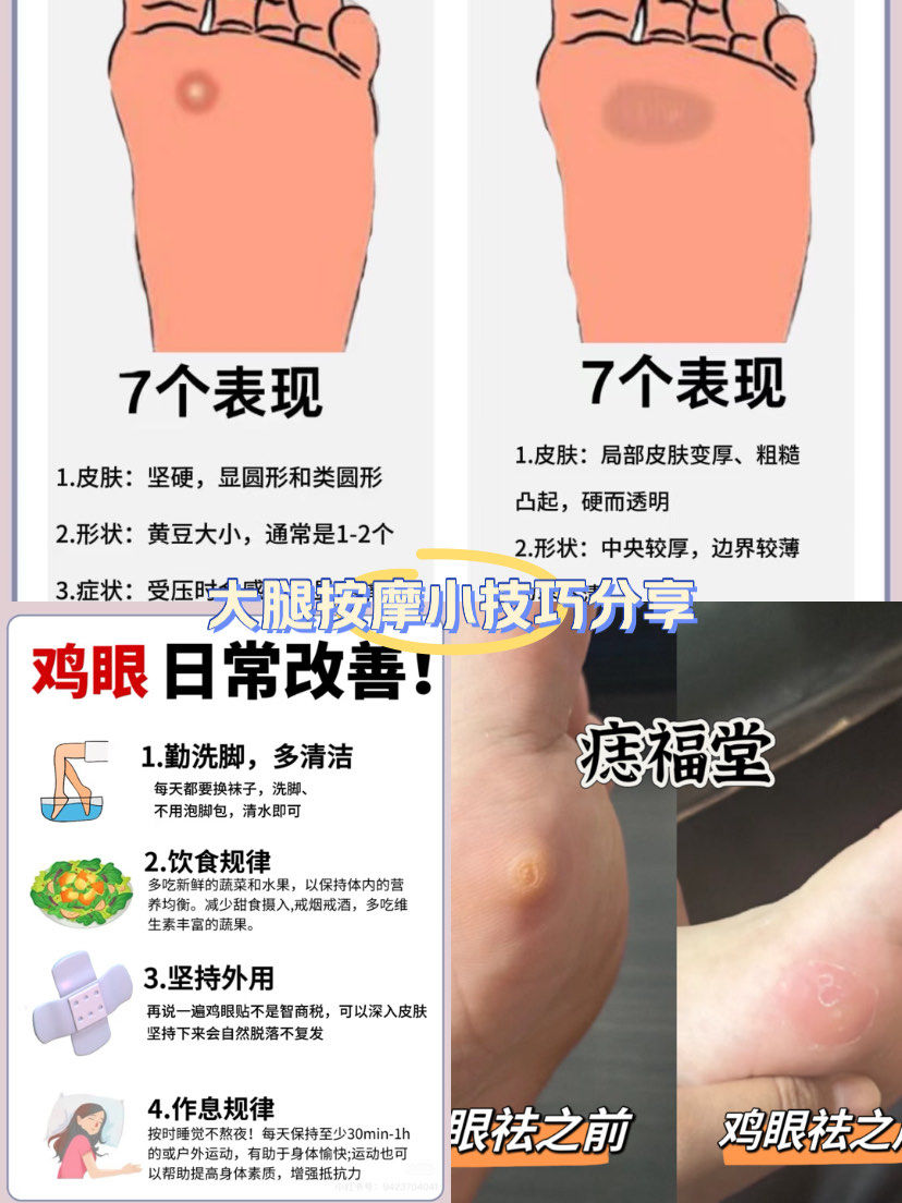 鸡眼是怎么形成的呢?