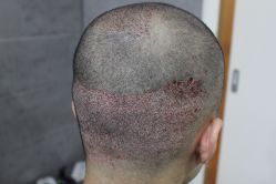 点击看大图 -大麦微针植发丨全国连锁