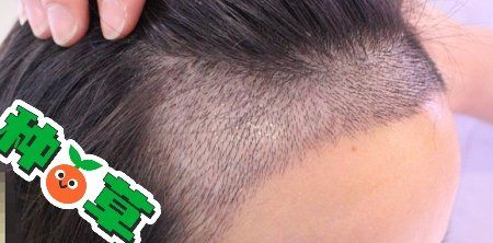 -大麦微针植发丨全国连锁