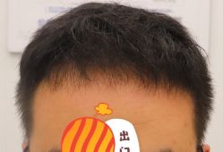 -大麦微针植发全国连锁