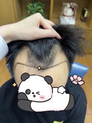 -大麦微针植发全国连锁