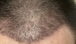 -大麦微针植发丨全国连锁