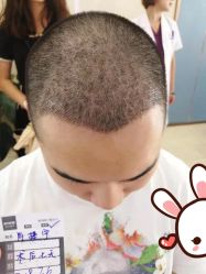 -大麦微针植发丨全国连锁