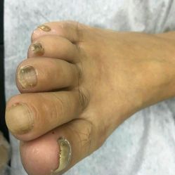 -德哥灰指甲脚气甲沟炎跖疣护理