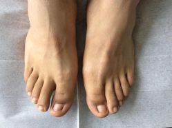 点击看大图 -德哥灰指甲脚气甲沟炎跖疣护理