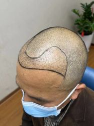 -大麦微针植发全国连锁