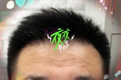 -大麦微针植发全国连锁