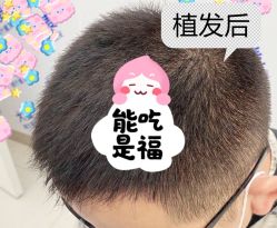 -大麦微针植发全国连锁
