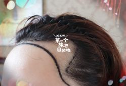 -大麦微针植发全国连锁