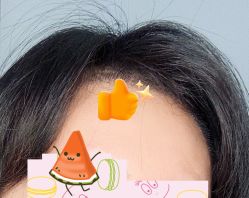 -大麦微针植发全国连锁