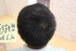 点击看大图 -大麦微针植发丨全国连锁