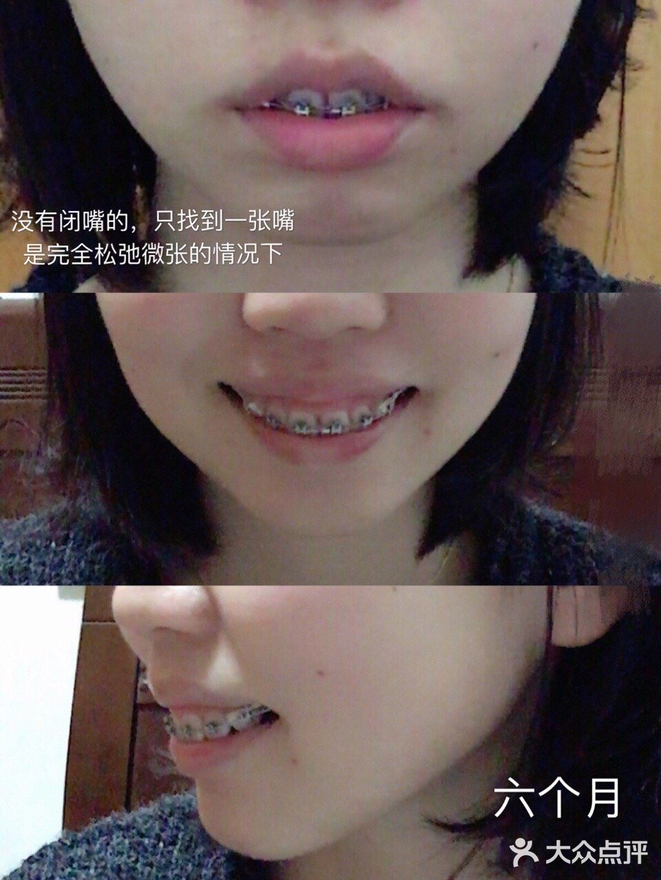 骨性深覆合金属自锁矫正案例 
