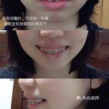 骨性深覆合金属自锁矫正案例 