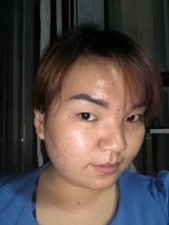 -荟草堂专业祛痘连锁机构