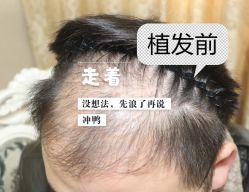 -大麦微针植发全国连锁