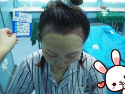 -大麦微针植发丨全国连锁