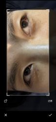 体验前-美丽人生祛斑扁平疣汗管瘤中心