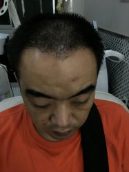 -大麦微针植发全国连锁