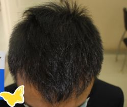 -大麦微针植发丨全国连锁