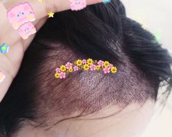 -大麦微针植发全国连锁