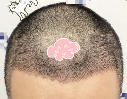 -大麦微针植发全国连锁