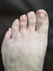 -派恩宜灰指甲鸡眼嵌甲手足癣