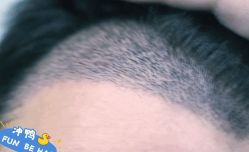 -大麦微针植发丨全国连锁