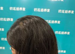 -碧莲盛·不剃发植发