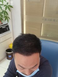 点击看大图 -大麦微针植发丨全国连锁