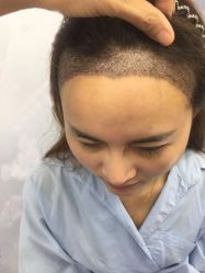 -大麦微针植发丨全国连锁