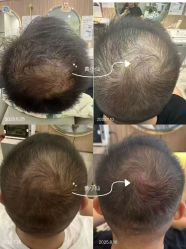 -希梵尔头皮抗衰·科技养发