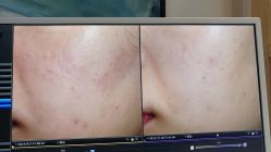 -苑苑vbeauty科技美容SPA