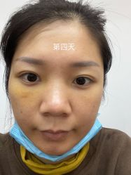 体验后-广州健丽·去眼袋医疗美容机构